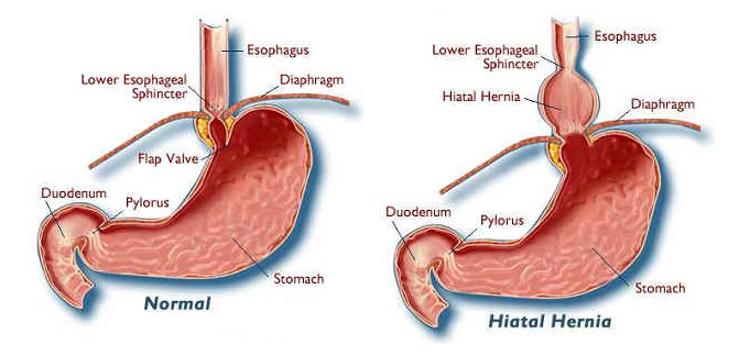 Hiatal Hernia Lump In Throat 35